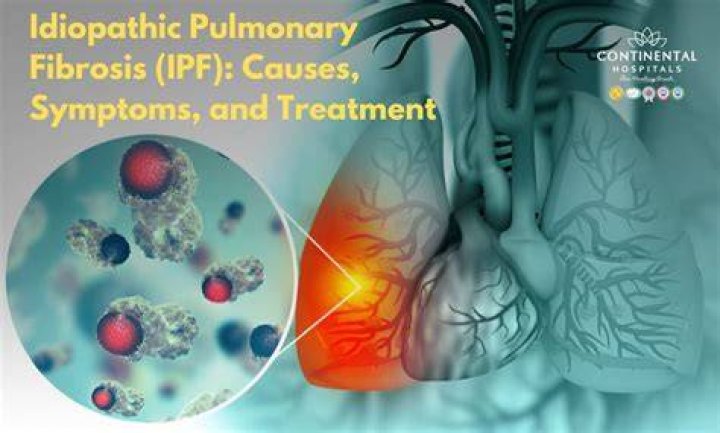 Can sarcoidosis be mistaken for IPF?