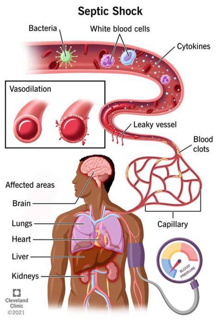 Can septic shock be prevented?