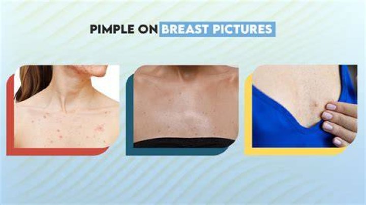 Can you Dermaroll your breasts?