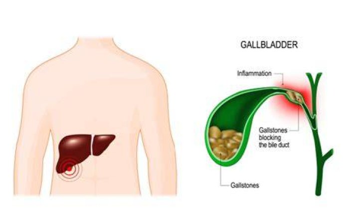 Can you have gallstones for years?
