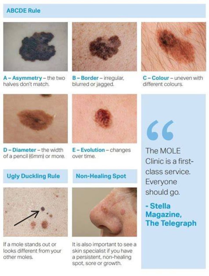 Do cancerous moles hurt?