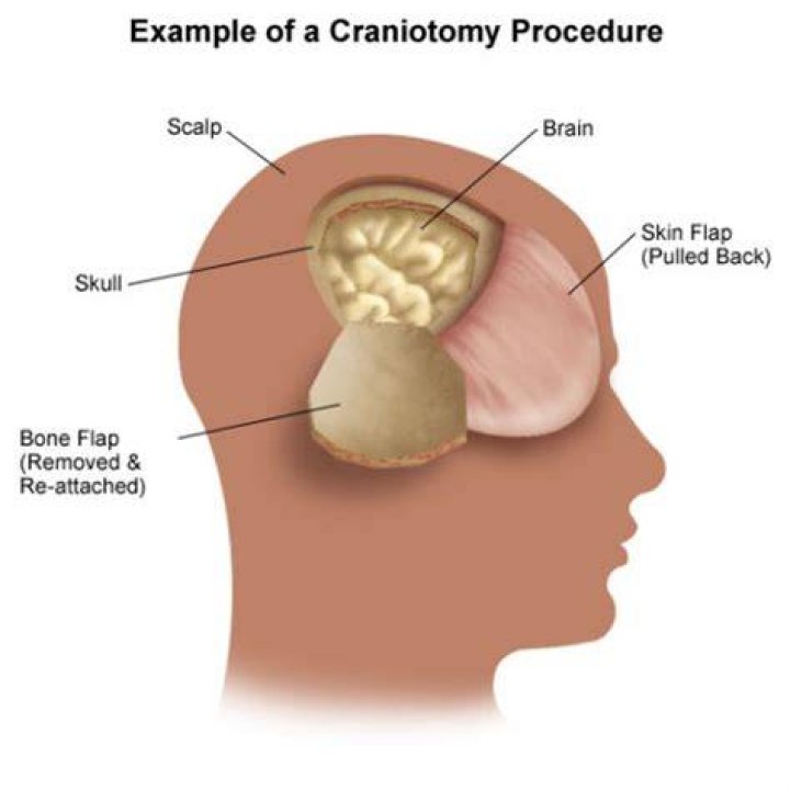 Do they put the skull back after brain surgery?