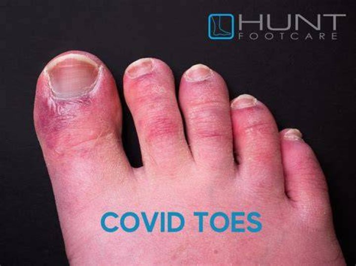 How do COVID toes start?