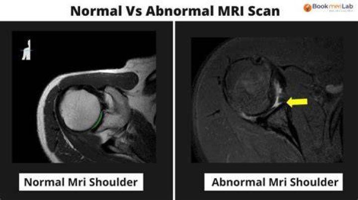How do you know if an MRI is abnormal?