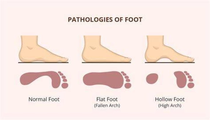 Is it OK to walk with flat feet?