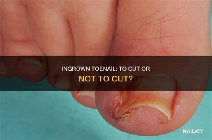 Should I cut the corner of my ingrown toenail?