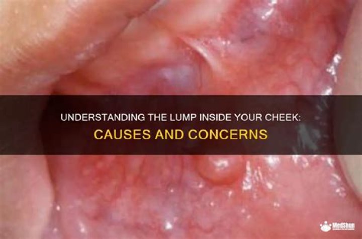What causes lump inside cheek?