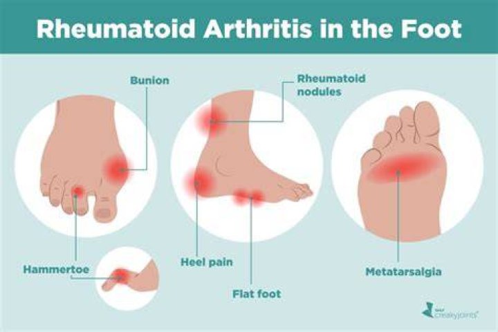 What does rheumatoid arthritis feel like in ankles?
