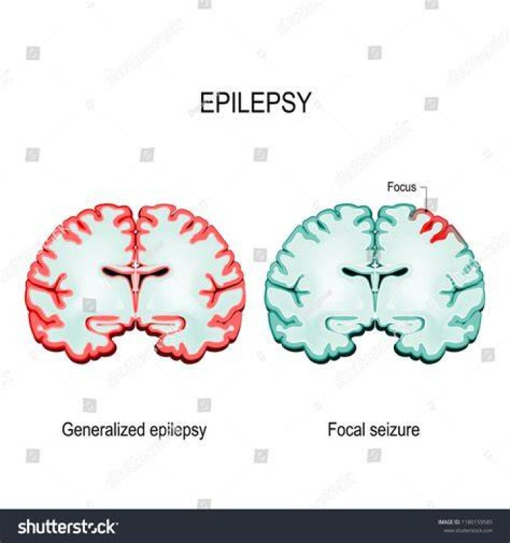 What part of the brain is affected by epilepsy?