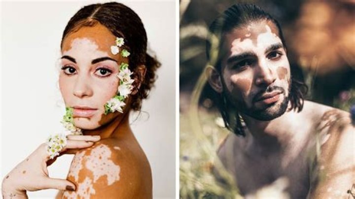 What vitiligo looks like?
